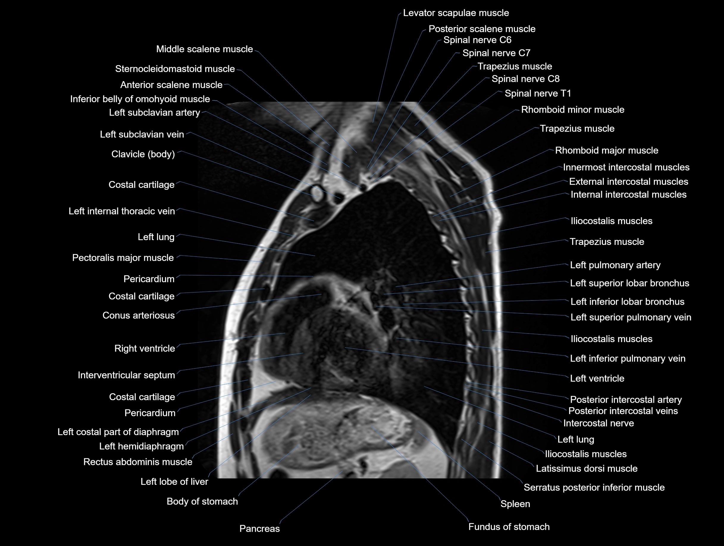 MRI chest (thorax) coronal  cross sectional anatomy 3T radiology  image-img-00001-00025.webp